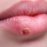 Herpes Labial