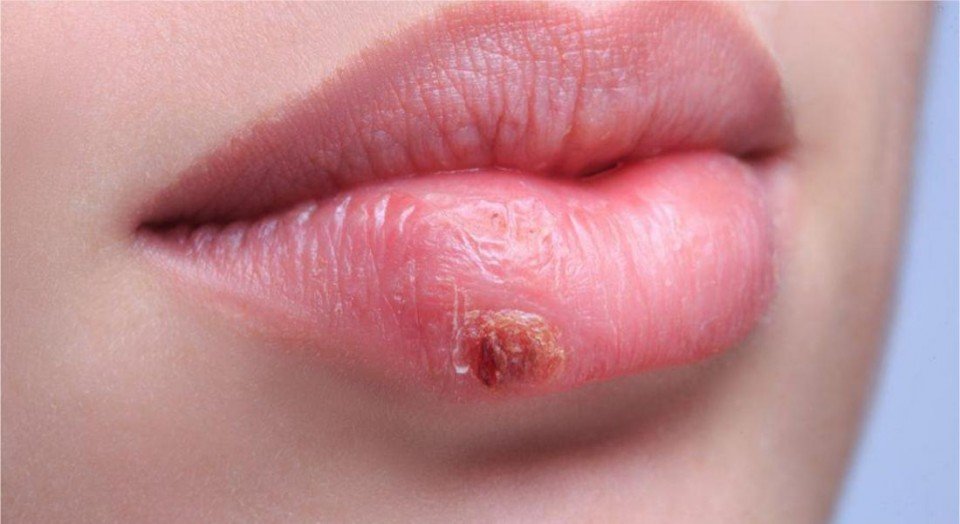Herpes Labial