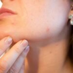 Pele Oleosa e Acne
