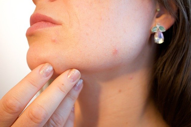 Pele-Oleosa-e-Acne Tratamentos para Pele Oleosa e Acne