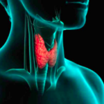 Problemas de Tireoide