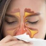 Congestão Nasal