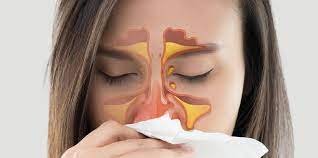 Congestão Nasal
