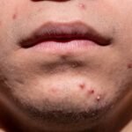 Tratar Naturalmente a Acne